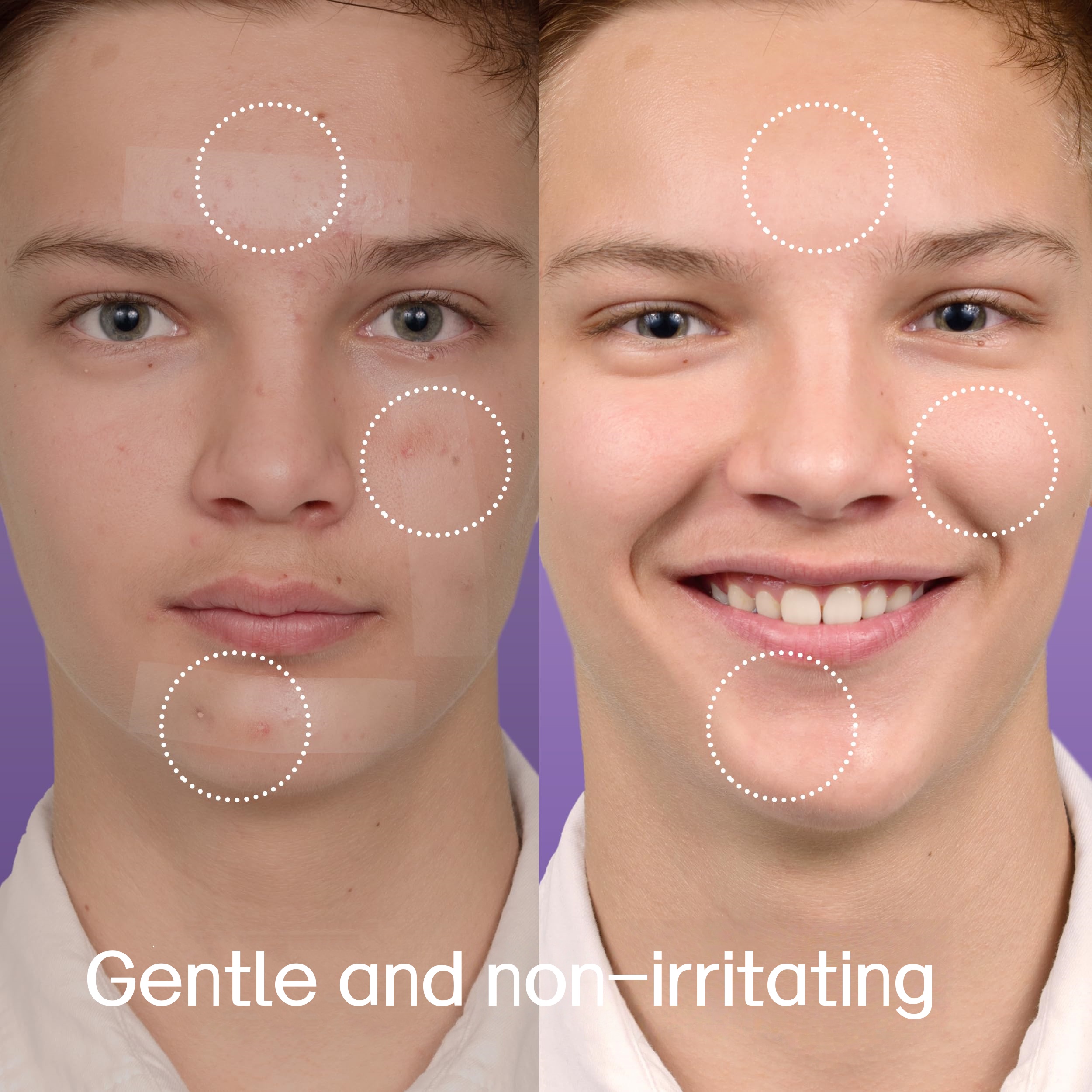 30 XL acne patches, suitable f - đánh giá và giá Xl Skincare